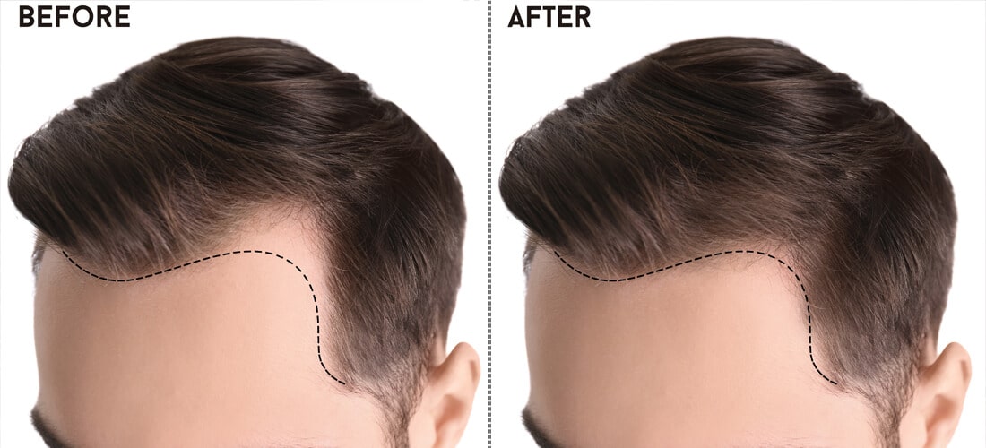 Hair Transplants in Pakistan